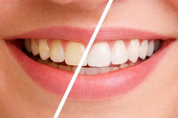 Vorher-Nachher-Vergleich nach professioneller Zahnreinigung (PZR) mit sichtbar aufgehellten und sauberen Zähnen